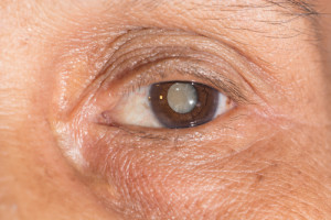 Linsentrübung im Auge führt zu einem Katarakt